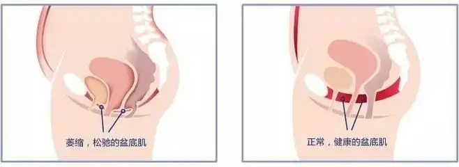 老公说你「松」了？图解「凯格尔」缩阴训练法插图