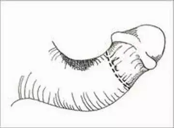 为啥有的人硬了却是弯的插图2